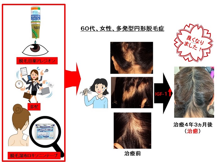 円形脱毛症　病院